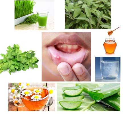 Canker Sore