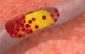 What is atherosclerosis