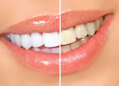 Teeth Whitener with Banana Peels